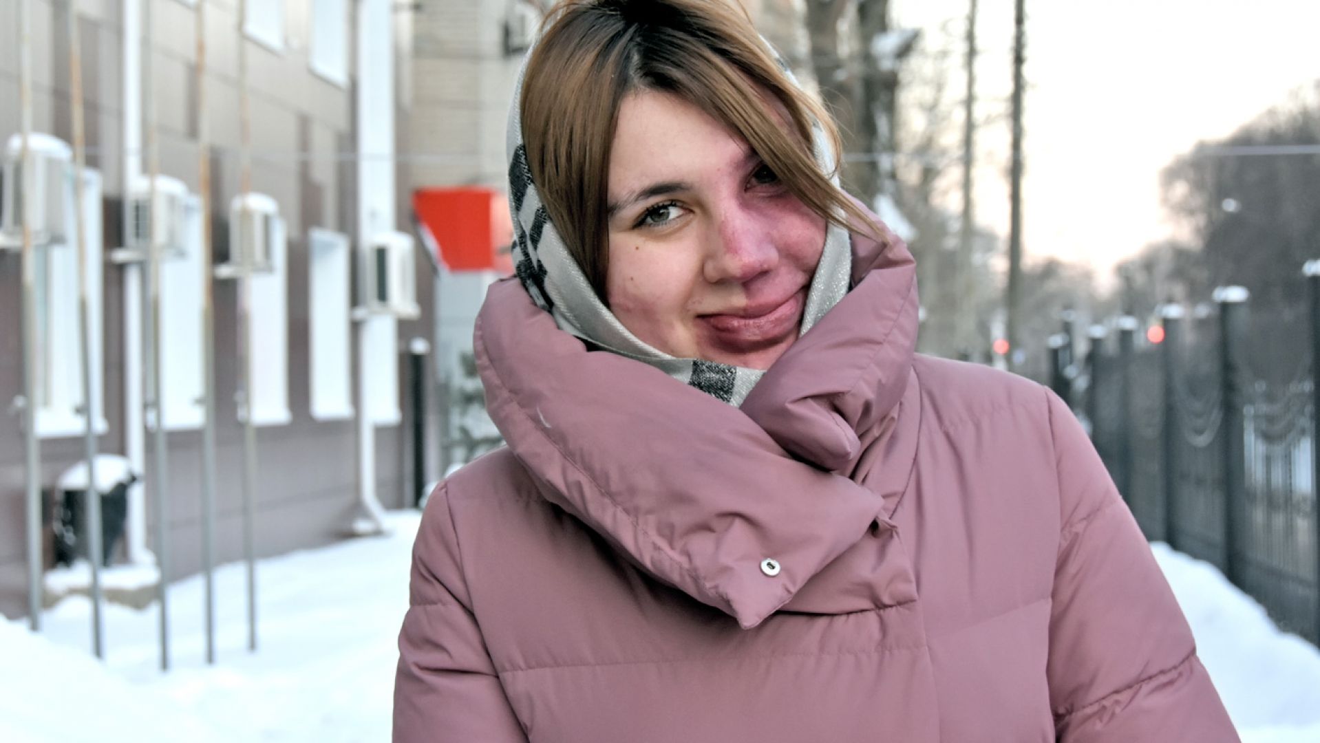 «Ненавидеть своё пятно было моей самой большой ошибкой»